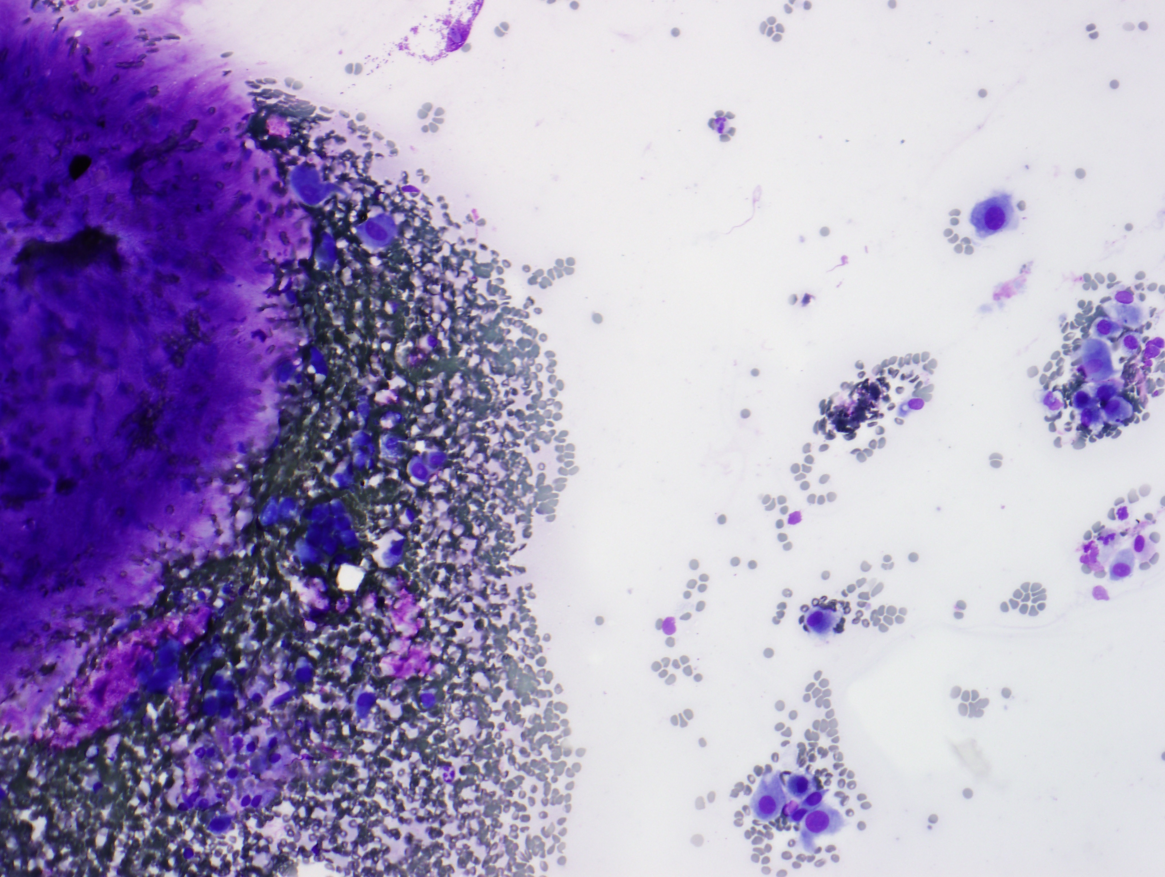 Figure 2: FNA of lung lesion, Diff Quik at 10x