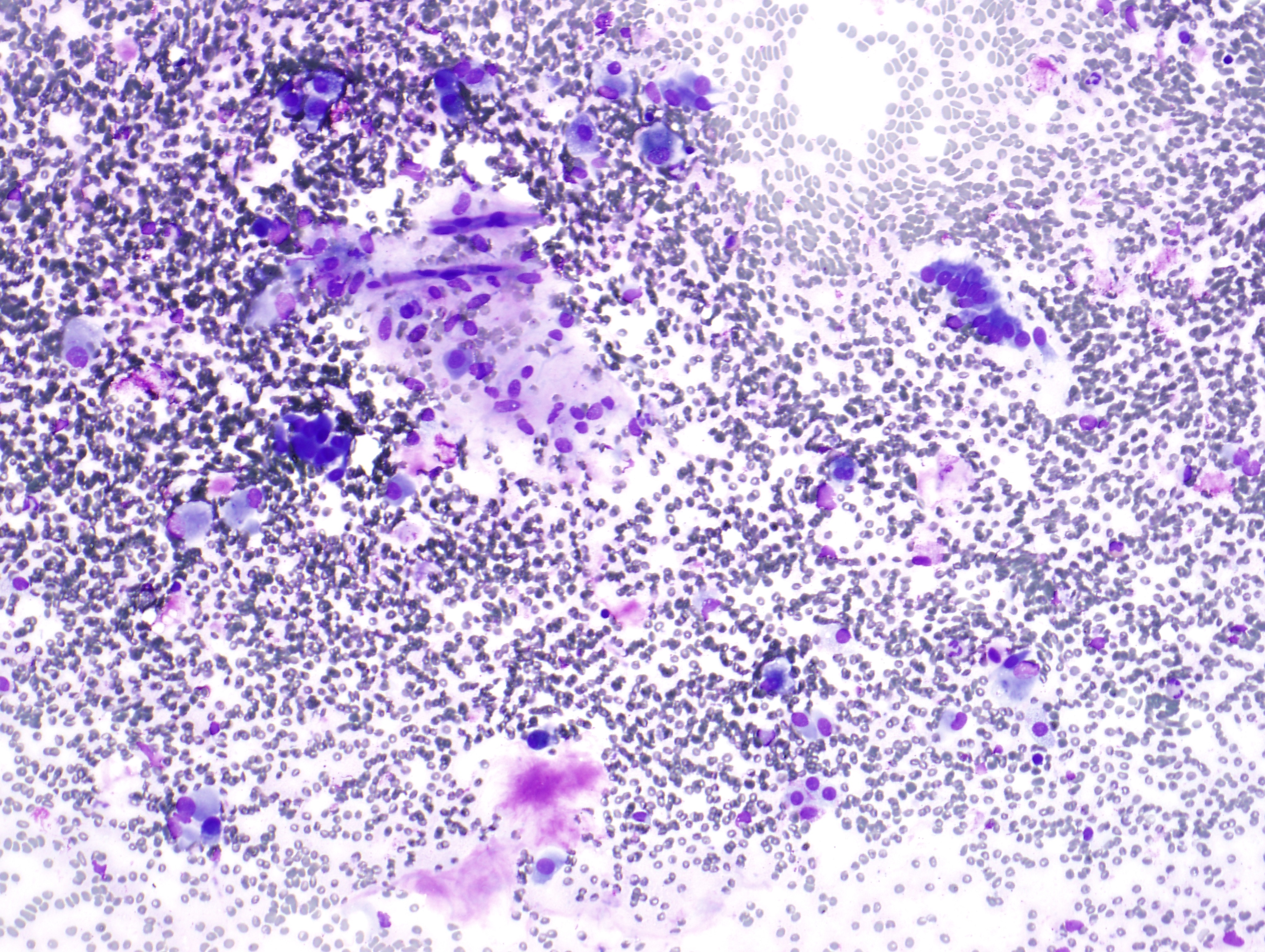 Figure 3:  FNA of lung lesion, Diff Quik at 10x