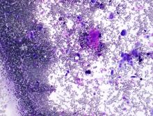  FNA of lung lesion, Diff Quik at 10x